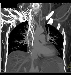 SVC Occlusion With Huge Collaterals and Thrombus Into Right Atrium - CTisus CT Scan