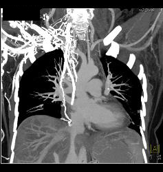 SVC Occlusion With Huge Collaterals and Thrombus Into Right Atrium - CTisus CT Scan