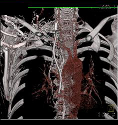 SVC Occlusion With Huge Collaterals and Thrombus Into Right Atrium - CTisus CT Scan