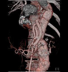 Bypass Grafts From Aorta to Mesenteric Vessels - CTisus CT Scan