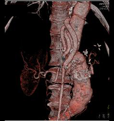 Bypass Grafts From Aorta to Mesenteric Vessels - CTisus CT Scan