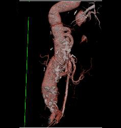 Bypass Grafts From Aorta to Mesenteric Vessels - CTisus CT Scan