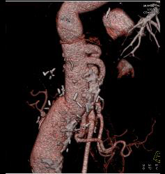 Bypass Grafts From Aorta to Mesenteric Vessels - CTisus CT Scan