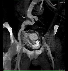 Pelvic Arteriovenous Malformation (AVM) With Embolization But Still Patent AVM - CTisus CT Scan