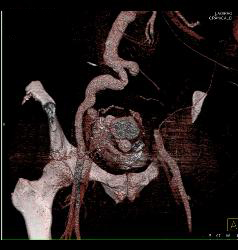 Pelvic Arteriovenous Malformation (AVM) With Embolization But Still Patent AVM - CTisus CT Scan