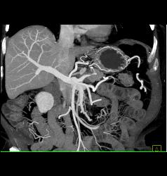 Mesenteric Arcade - CTisus CT Scan