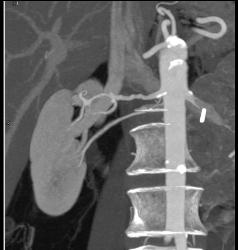 Fibromuscular Dysplasia- FMD - Upper Renal Artery - CTisus CT Scan