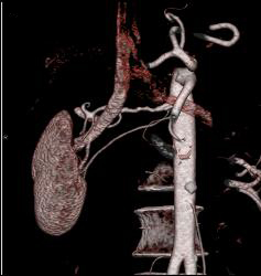 Fibromuscular Dysplasia- FMD - Upper Renal Artery - CTisus CT Scan