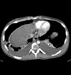 Thrombus in Inferior Vena Cava (IVC) - CTisus CT Scan