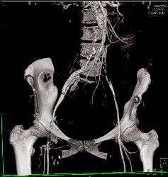 Extensive Disease With Occluded Iliac Artery and Occluded Fem-fem Grafts - CTisus CT Scan