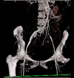 Extensive Disease With Occluded Iliac Artery and Occluded Fem-fem Grafts - CTisus CT Scan