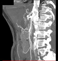 Stent in Superior Mesenteric Artery (SMA) and Celiac Artery With Extensive Disease - CTisus CT Scan