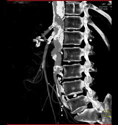 Stent in Superior Mesenteric Artery (SMA) and Celiac Artery With Extensive Disease - CTisus CT Scan