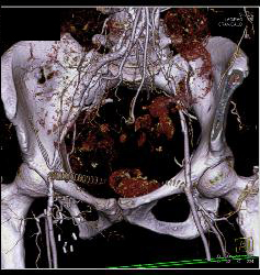 Stent in Superior Mesenteric Artery (SMA) and Celiac Artery With Extensive Disease - CTisus CT Scan