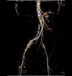 Stent in Superior Mesenteric Artery (SMA) and Celiac Artery With Extensive Disease - CTisus CT Scan