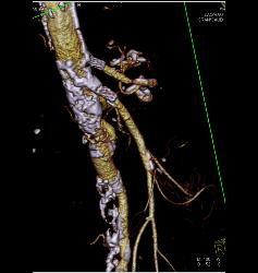 Stent in Superior Mesenteric Artery (SMA) and Celiac Artery With Extensive Disease - CTisus CT Scan