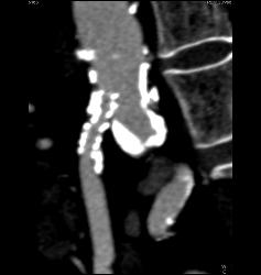 Stent in Superior Mesenteric Artery (SMA) and Celiac Artery With Extensive Disease - CTisus CT Scan