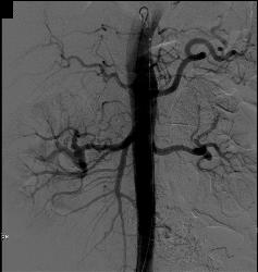 CTA Angiogram of Fibromuscular Dysplasia - CTisus CT Scan