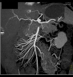 Mesenteric Arcade and Fibromuscular Dysplasia (FMD) of Right Renal Artery - CTisus CT Scan