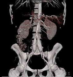 Ehlers-Danlos Involves the Iliac Arteries - CTisus CT Scan