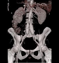 Ehlers-Danlos Involves the Iliac Arteries - CTisus CT Scan