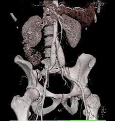 Ehlers-Danlos Involves the Iliac Arteries - CTisus CT Scan