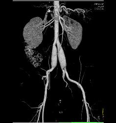 Ehlers-Danlos Involves the Iliac Arteries - CTisus CT Scan