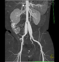 Ehlers-Danlos Involves the Iliac Arteries - CTisus CT Scan