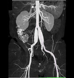 Ehlers-Danlos Involves the Iliac Arteries - CTisus CT Scan