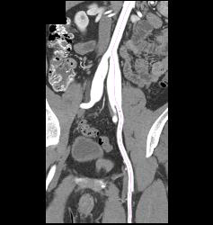 Ehlers-Danlos Involves the Iliac Arteries - CTisus CT Scan