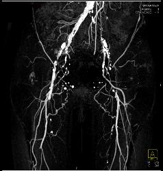 Diseased Iliac Arteries With Stenosis - CTisus CT Scan