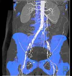 Diseased Iliac Arteries With Stenosis - CTisus CT Scan