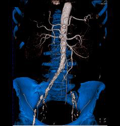 Diseased Iliac Arteries With Stenosis - CTisus CT Scan