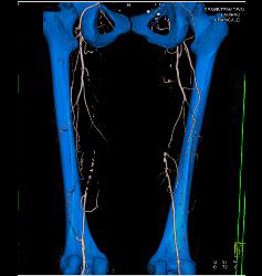 Peripheral Vascular Disease (PVD) With CTA - CTisus CT Scan