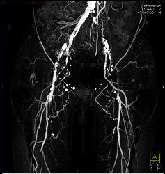 Peripheral Vascular Disease (PVD) With CTA - CTisus CT Scan