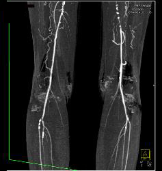 Peripheral Vascular Disease (PVD) With CTA - CTisus CT Scan