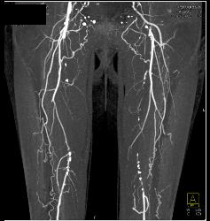 Peripheral Vascular Disease (PVD) With CTA - CTisus CT Scan