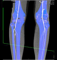 Peripheral Vascular Disease (PVD) With CTA - CTisus CT Scan