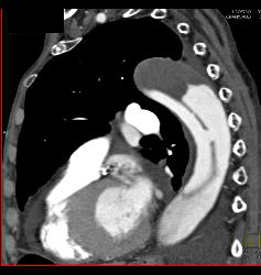 Type B Dissection - CTisus CT Scan