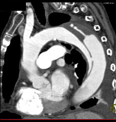 Type B Dissection - CTisus CT Scan