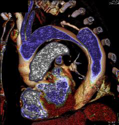 Type B Dissection - CTisus CT Scan