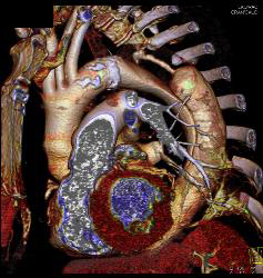 Type B Dissection - CTisus CT Scan