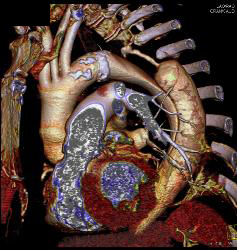 Aortic Dissection With MIP Display - CTisus CT Scan