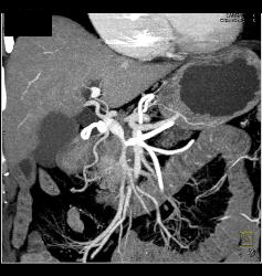 Median Arcuate Ligament Syndrome With Dilated Gastroduodenal Artery (GDA) - CTisus CT Scan