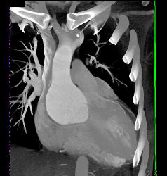 Marfan Syndrome With Dilated Aortic Root - CTisus CT Scan