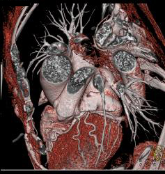 Ccta: Normal Coronary Arteries - CTisus CT Scan