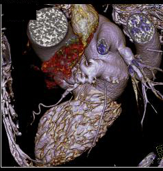 Ccta: Normal Coronary Arteries - CTisus CT Scan