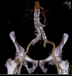 Endovascular Stents - CTisus CT Scan