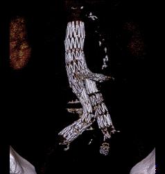 Endovascular Stents - CTisus CT Scan