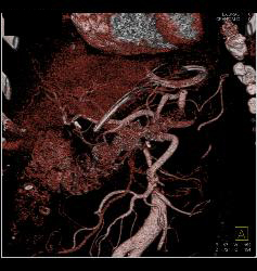 Repair of Superior Mesenteric Artery (SMA) Aneurysm With Post Op Changes - CTisus CT Scan